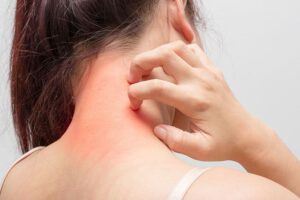 Atopische Dermatitis. Was hilft gegen trockene, juckende Haut?
