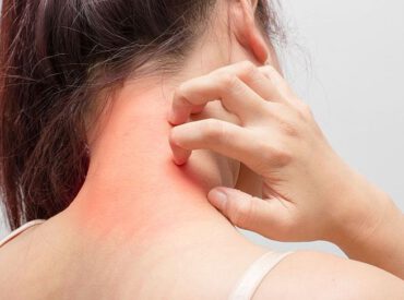 Die Haut mit der atopischen Dermatitis ist sehr trocken und juckend. Das ist eine allergische Reaktion der Haut auf den Kontakt mit einem Allergen.